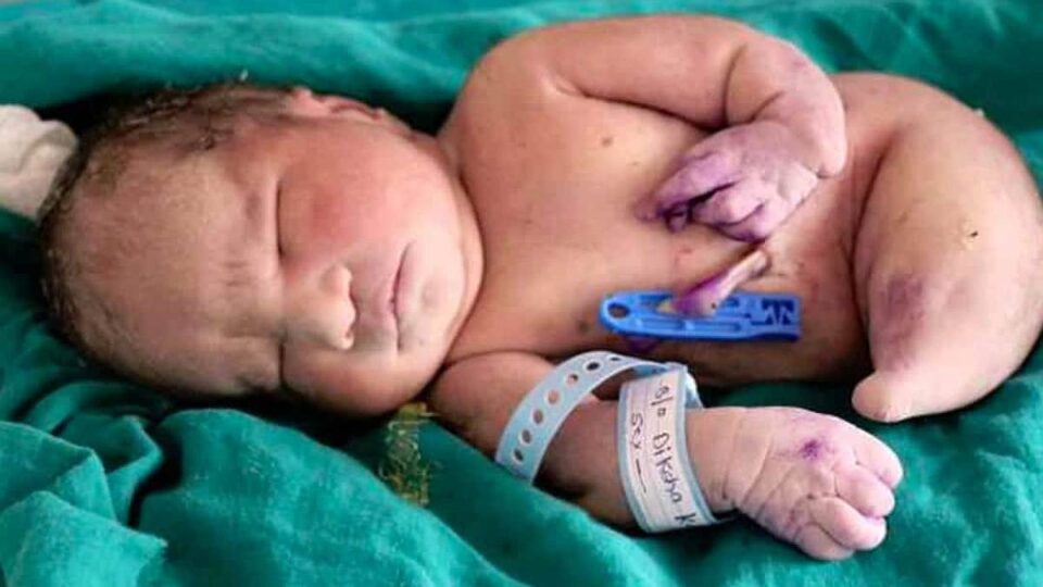 Un bébé né avec le syndrome de la sirène en Inde : une tragédie rare